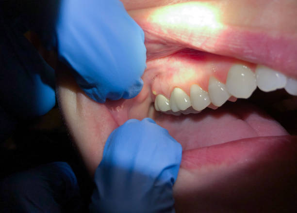 Best Lost Filling or Crown Replacement in Liberty, SC